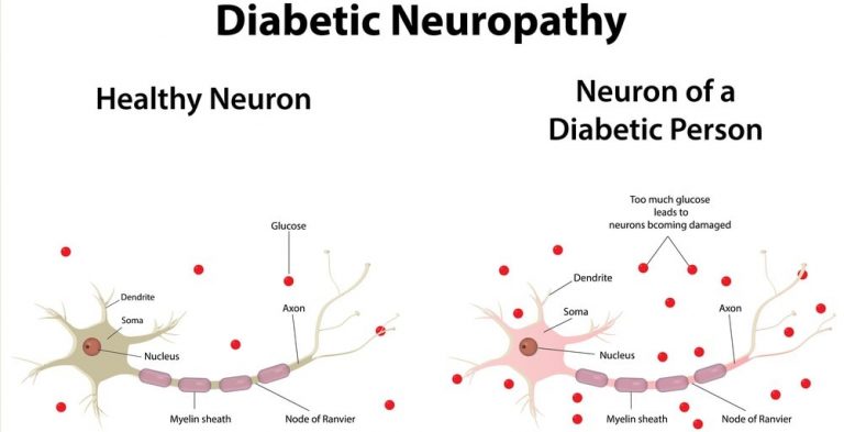 diabetic-neuropathy-pain-pharmacy-gyan