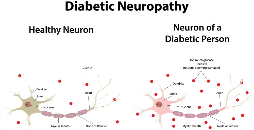 Diabetic neuropathy pain