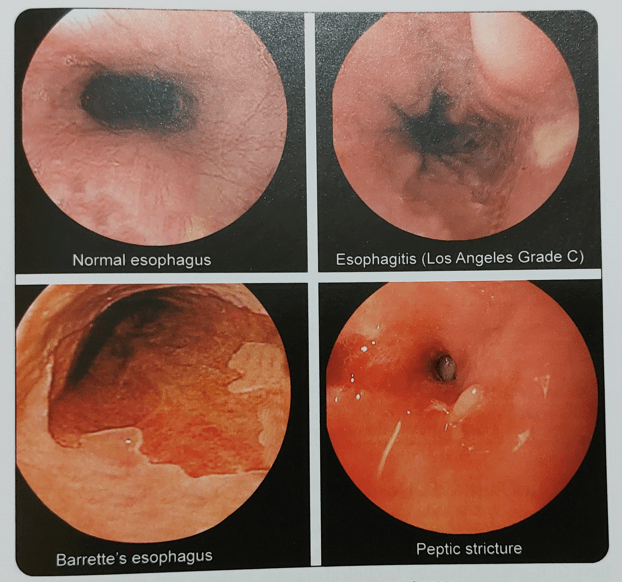 Gastroesophageal reflux disease (GERD) Epidemiology